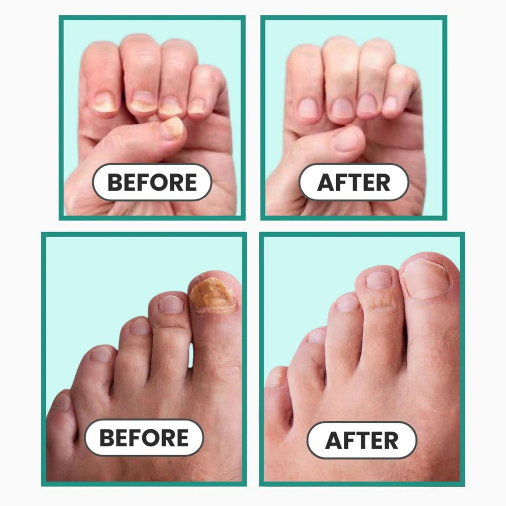 NailVital Device