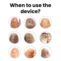 NailVital Device