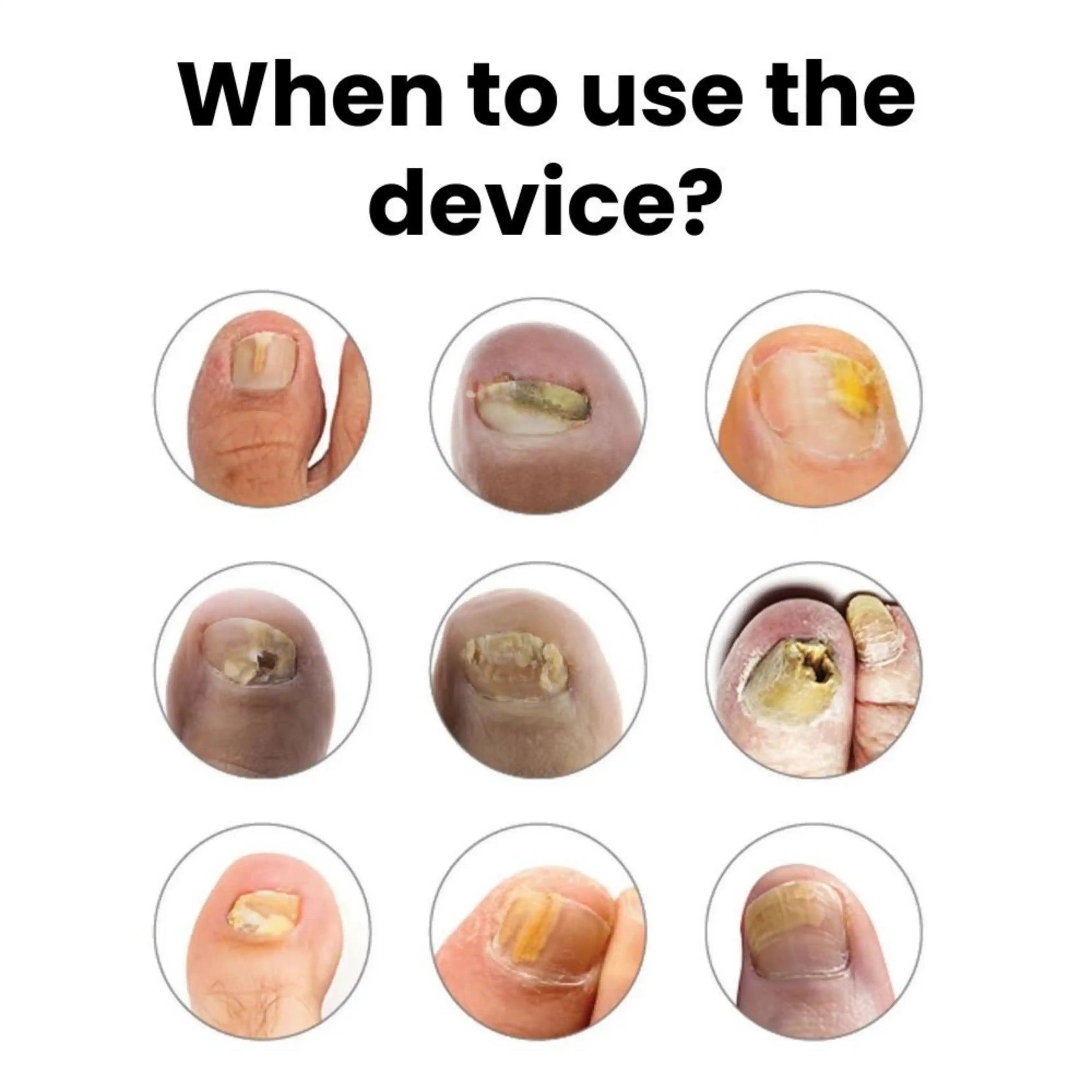 NailVital Device
